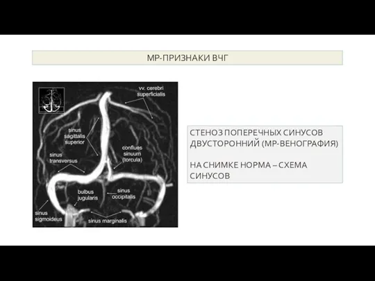 МР-признаки ВЧГ СТЕНОЗ ПОПЕРЕЧНЫХ СИНУСОВ ДВУСТОРОННИЙ (МР-ВЕНОГРАФИЯ) НА СНИМКЕ НОРМА – СХЕМА СИНУСОВ МР-ПРИЗНАКИ ВЧГ