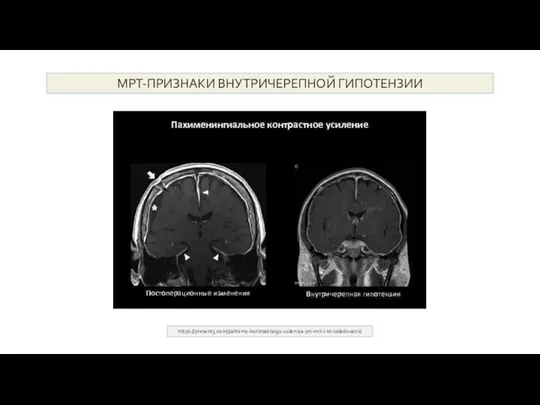 МРТ-ПРИЗНАКИ ВНУТРИЧЕРЕПНОЙ ГИПОТЕНЗИИ https://present5.com/patterny-kontrastnogo-usileniya-pri-mrt-i-kt-issledovanii/