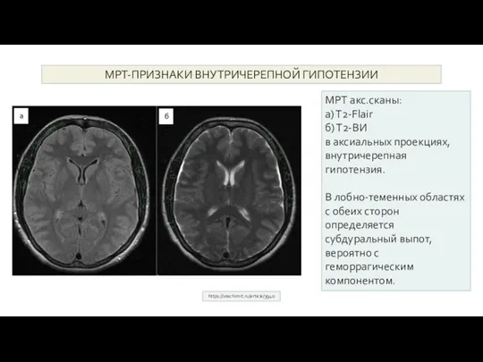 МРТ-ПРИЗНАКИ ВНУТРИЧЕРЕПНОЙ ГИПОТЕНЗИИ https://vrachimrt.ru/article/3940 МРТ акс.сканы: а) Т2-Flair б) Т2-ВИ в аксиальных