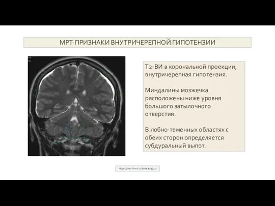 МРТ-ПРИЗНАКИ ВНУТРИЧЕРЕПНОЙ ГИПОТЕНЗИИ https://vrachimrt.ru/article/3940 Т2-ВИ в корональной проекции, внутричерепная гипотензия. Миндалины мозжечка