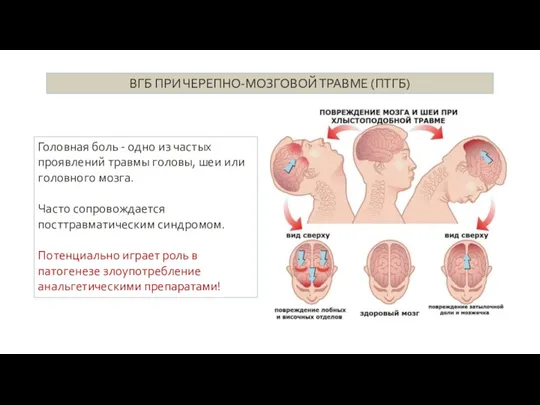 ВГБ ПРИ ЧЕРЕПНО-МОЗГОВОЙ ТРАВМЕ (ПТГБ) Головная боль - одно из частых проявлений