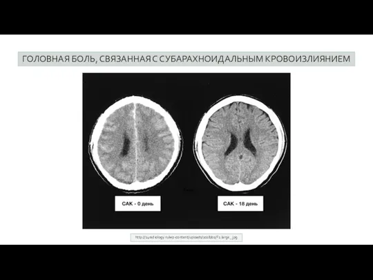 ГОЛОВНАЯ БОЛЬ, СВЯЗАННАЯ С СУБАРАХНОИДАЛЬНЫМ КРОВОИЗЛИЯНИЕМ http://24radiology.ru/wp-content/uploads/2018/02/F2.large_.jpg