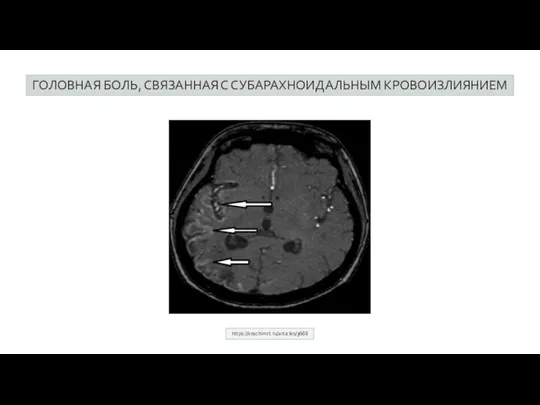 ГОЛОВНАЯ БОЛЬ, СВЯЗАННАЯ С СУБАРАХНОИДАЛЬНЫМ КРОВОИЗЛИЯНИЕМ https://vrachimrt.ru/articles/3668