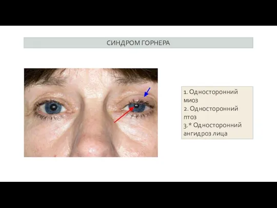 СИНДРОМ ГОРНЕРА 1. Односторонний миоз 2. Односторонний птоз 3.* Односторонний ангидроз лица