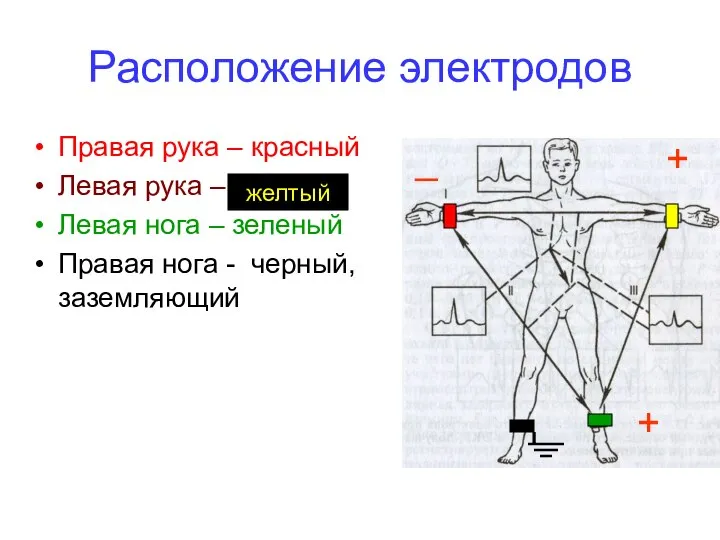 Расположение электродов Правая рука – красный Левая рука – Левая нога –