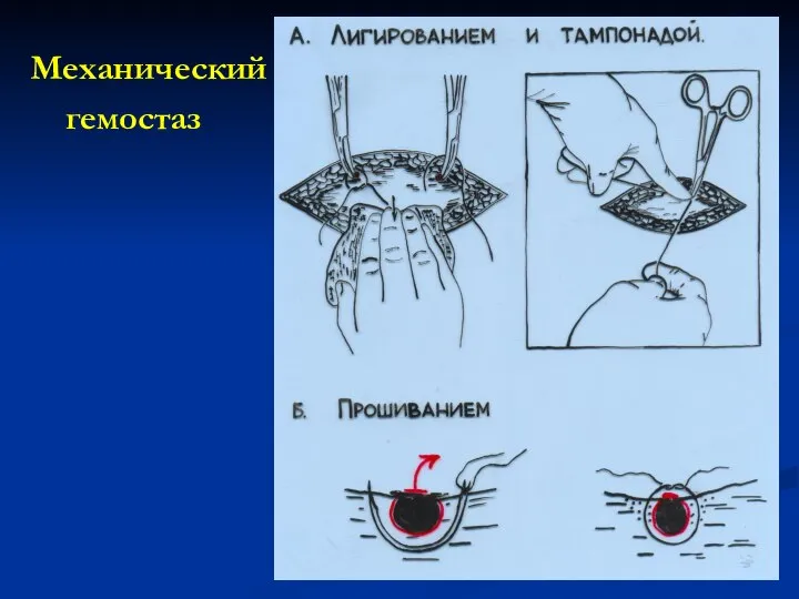 Механический гемостаз