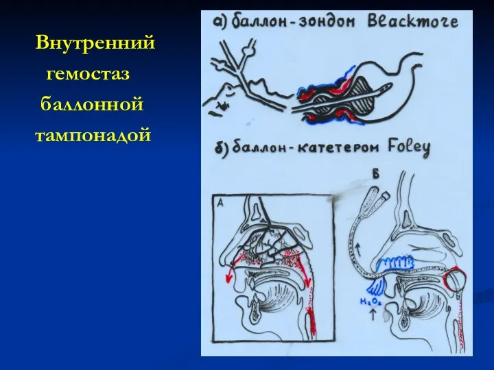 Внутренний гемостаз баллонной тампонадой