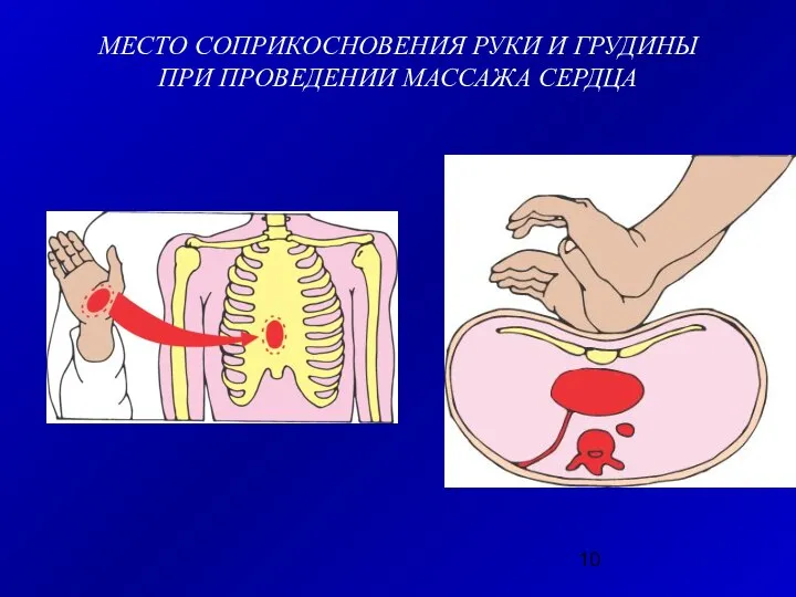 МЕСТО СОПРИКОСНОВЕНИЯ РУКИ И ГРУДИНЫ ПРИ ПРОВЕДЕНИИ МАССАЖА СЕРДЦА