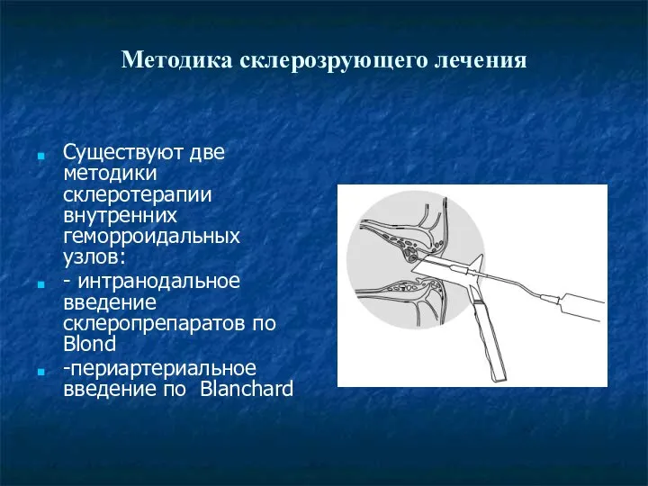 Методика склерозрующего лечения Существуют две методики склеротерапии внутренних геморроидальных узлов: - интранодальное