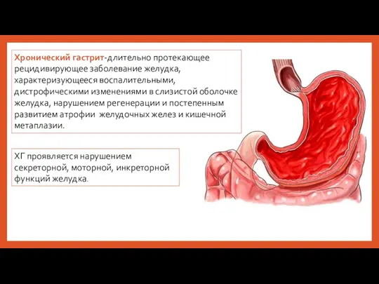 Хронический гастрит-длительно протекающее рецидивирующее заболевание желудка, характеризующееся воспалительными, дистрофическими изменениями в слизистой