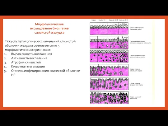 Морфологическое исследование биоптатов слизистой желудка Тяжесть патологических изменений слизистой оболочки желудка оценивается