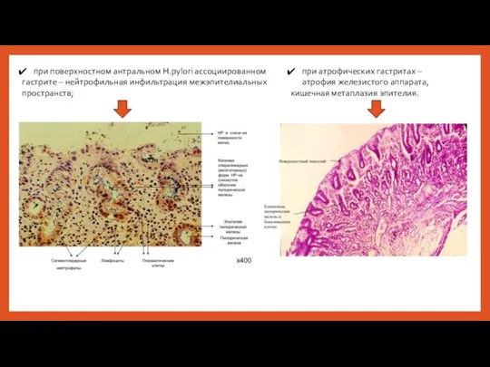 при поверхностном антральном H.pylori ассоциированном гастрите – нейтрофильная инфильтрация межэпителиальных пространств; при