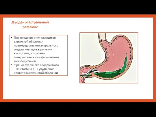 Дуоденогастральный рефлюкс Повреждение эпителиоцитов слизистой оболочки преимущественно антрального отдела желудка желчными кислотами,