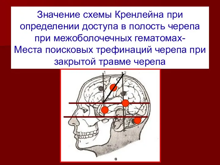 Значение схемы Кренлейна при определении доступа в полость черепа при межоболочечных гематомах-