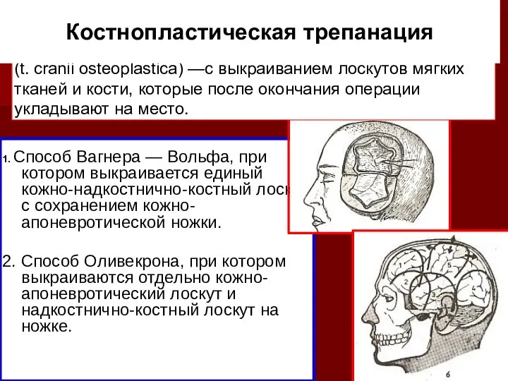 (t. cranii osteoplastica) —с выкраиванием лоскутов мягких тканей и кости, которые после