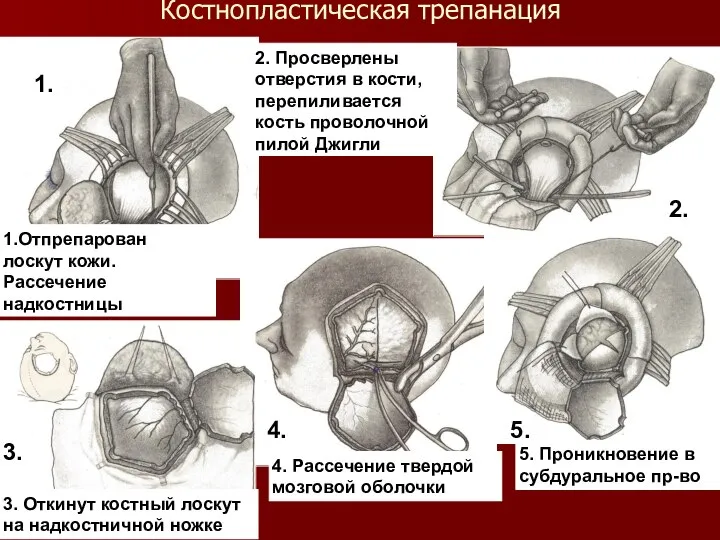 Костнопластическая трепанация 1.Отпрепарован лоскут кожи. Рассечение надкостницы 2. Просверлены отверстия в кости,