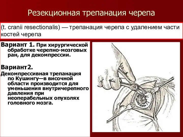 Резекционная трепанация черепа (t. cranii resectionalis) — трепанация черепа с удалением части костей черепа