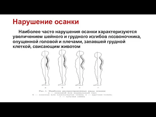 Нарушение осанки Наиболее часто нарушения осанки характеризуются увеличением шейного и грудного изгибов