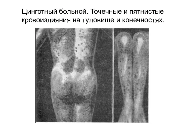 Цинготный больной. Точечные и пятнистые кровоизлияния на туловище и конечностях.