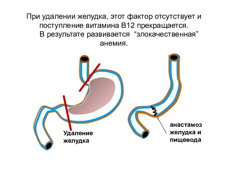 При удалении желудка, этот фактор отсутствует и поступление витамина В12 прекращается. В