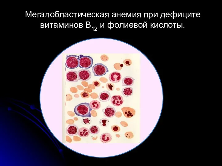 Мегалобластическая анемия при дефиците витаминов В12 и фолиевой кислоты.