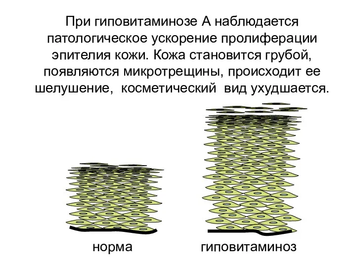 При гиповитаминозе А наблюдается патологическое ускорение пролиферации эпителия кожи. Кожа становится грубой,