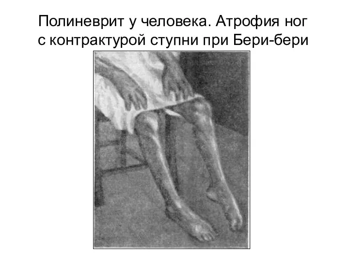 Полиневрит у человека. Атрофия ног с контрактурой ступни при Бери-бери