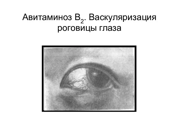 Авитаминоз В2. Васкуляризация роговицы глаза