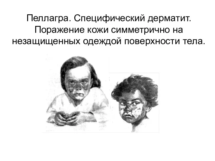 Пеллагра. Специфический дерматит. Поражение кожи симметрично на незащищенных одеждой поверхности тела.