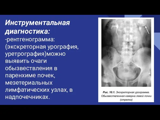 Инструментальная диагностика: -рентгенограмма: (экскреторная урография, уретрография)можно выявить очаги обызвествления в паренхиме почек,