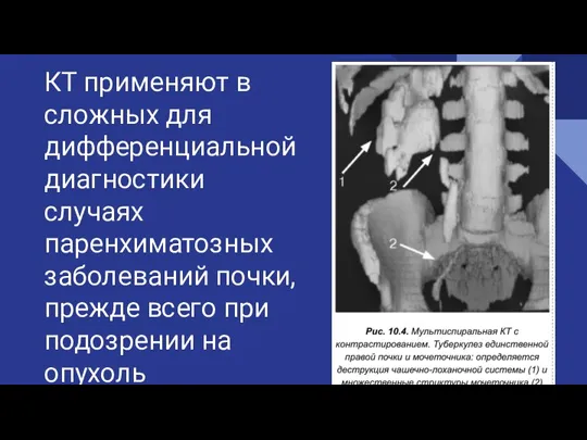 КТ применяют в сложных для дифференциальной диагностики случаях паренхиматозных заболеваний почки, прежде