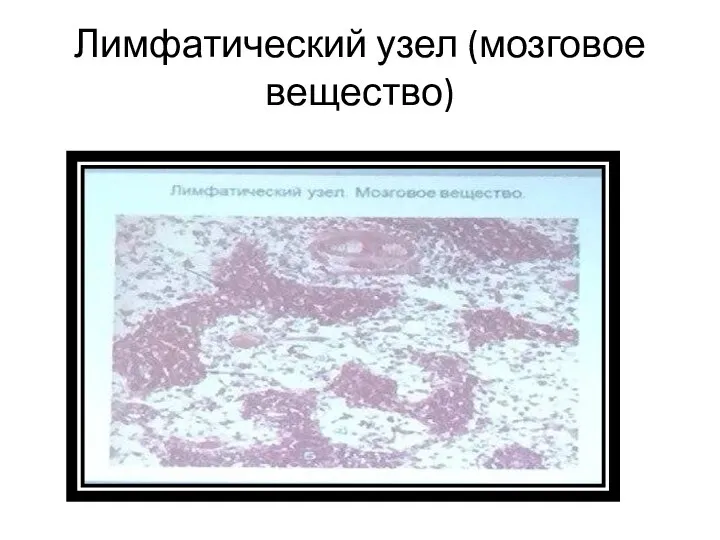 Лимфатический узел (мозговое вещество)