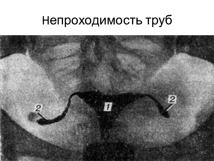 Hепроходимость труб