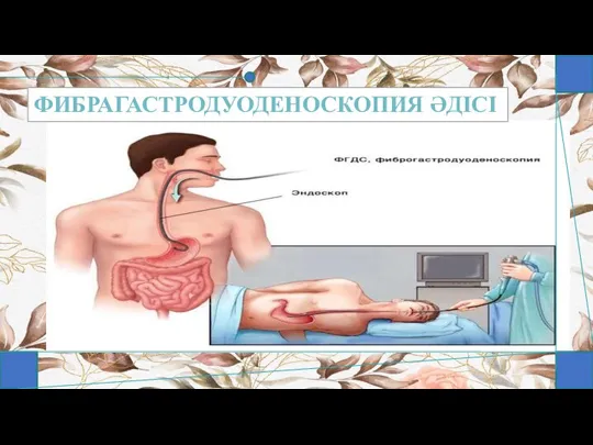 ФИБРАГАСТРОДУОДЕНОСКОПИЯ ӘДІСІ