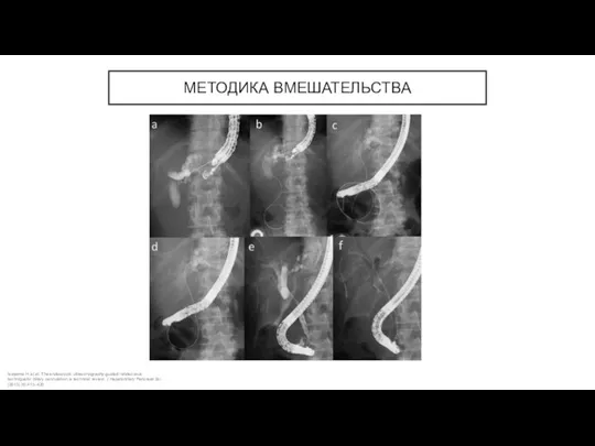 МЕТОДИКА ВМЕШАТЕЛЬСТВА Isayama H. et al. The endoscopic ultrasonography-guided rendezvous techniquefor biliary