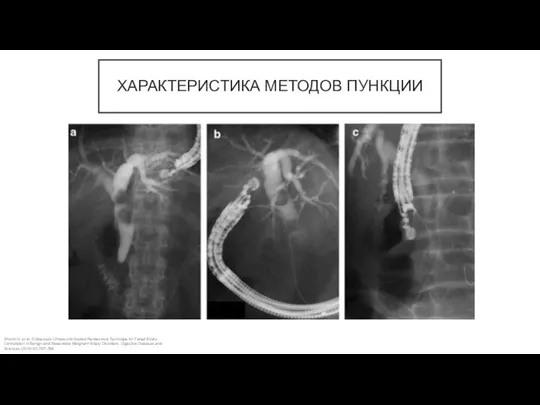 ХАРАКТЕРИСТИКА МЕТОДОВ ПУНКЦИИ Shiomi H. et al. Endoscopic Ultrasound‑Guided Rendezvous Technique for