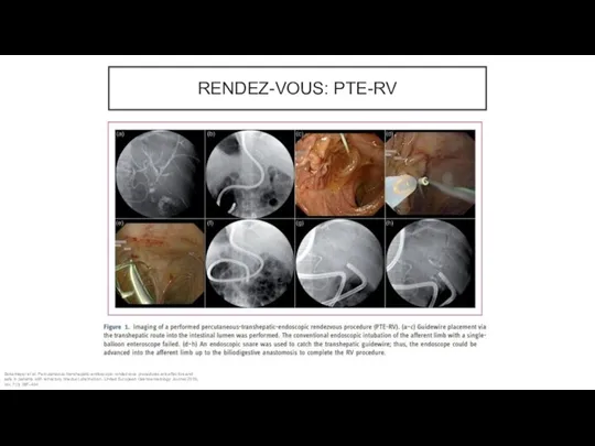 RENDEZ-VOUS: PTE-RV Bokemeyer et al. Percutaneous-transhepatic-endoscopic rendezvous procedures are effective and safe