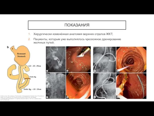 ПОКАЗАНИЯ Хирургически изменённая анатомия верхних отделов ЖКТ; Пациенты, которым уже выполнялось чрескожное