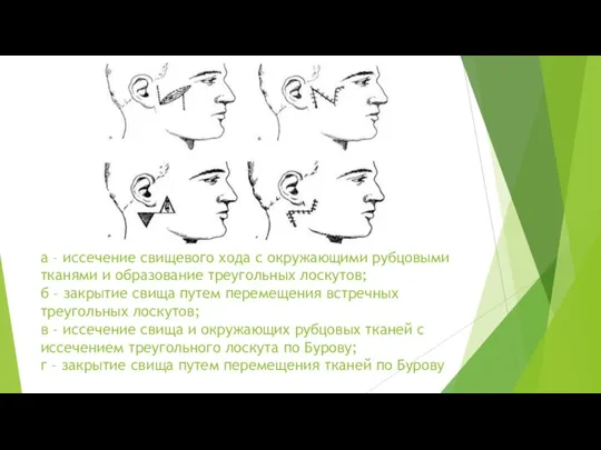 а – иссечение свищевого хода с окружающими рубцовыми тканями и образование треугольных