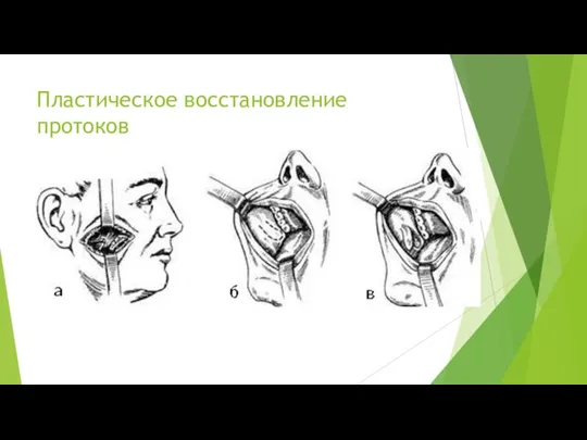 Пластическое восстановление протоков