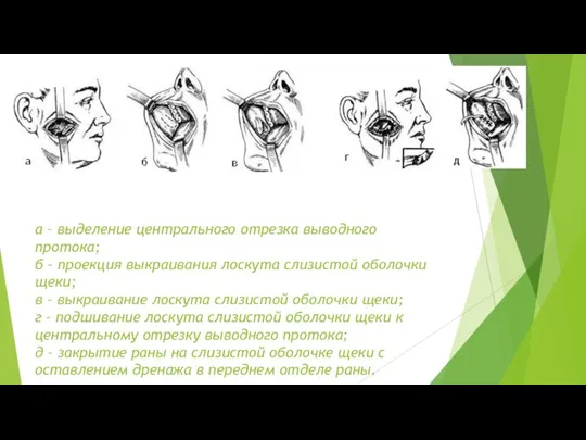 а – выделение центрального отрезка выводного протока; б – проекция выкраивания лоскута