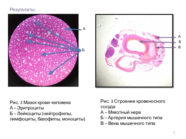 Результаты: А Б Рис. 2 Мазок крови человека А – Эритроциты Б