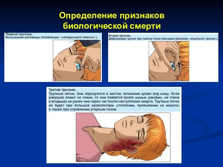 Определение признаков биологической смерти