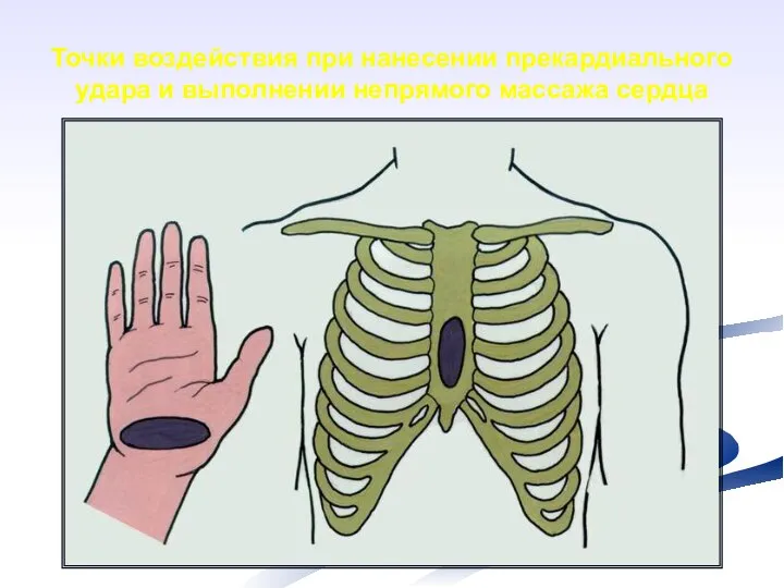 Точки воздействия при нанесении прекардиального удара и выполнении непрямого массажа сердца