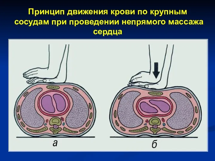 Принцип движения крови по крупным сосудам при проведении непрямого массажа сердца