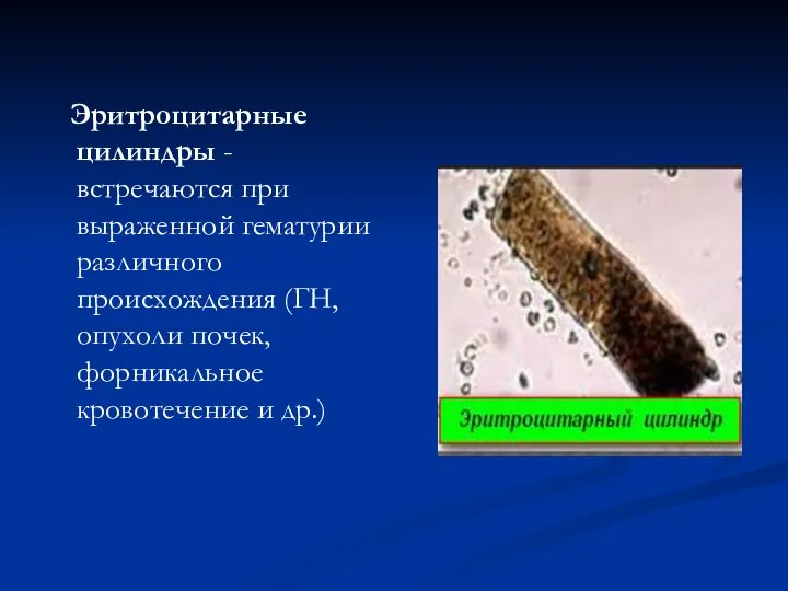 Эритроцитарные цилиндры - встречаются при выраженной гематурии различного происхождения (ГН, опухоли почек, форникальное кровотечение и др.)