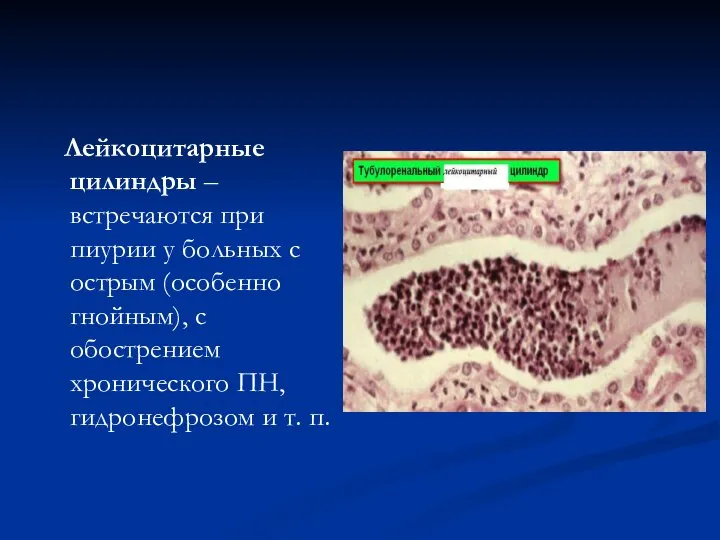 Лейкоцитарные цилиндры – встречаются при пиурии у больных с острым (особенно гнойным),