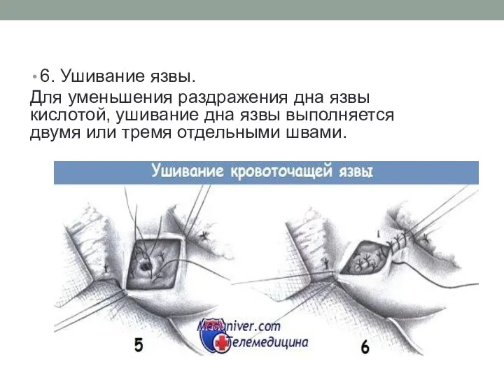 6. Ушивание язвы. Для уменьшения раздражения дна язвы кислотой, ушивание дна язвы