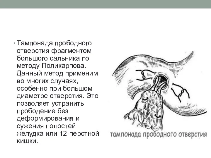 Тампонада прободного отверстия фрагментом большого сальника по методу Поликарпова. Данный метод применим