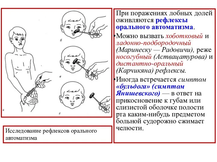 При поражениях лобных долей оживляются рефлексы орального автоматизма. Можно вызвать хоботковый и